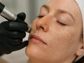 Pigment & Hyper Pigmentation Removal