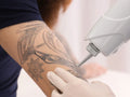 Tattoo Removal