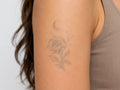 TATTOO REMOVAL