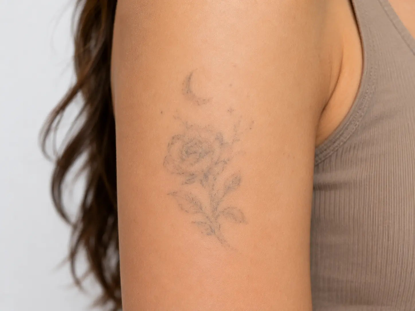 TATTOO REMOVAL