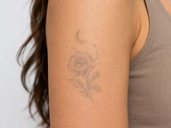 Tattoo Removal